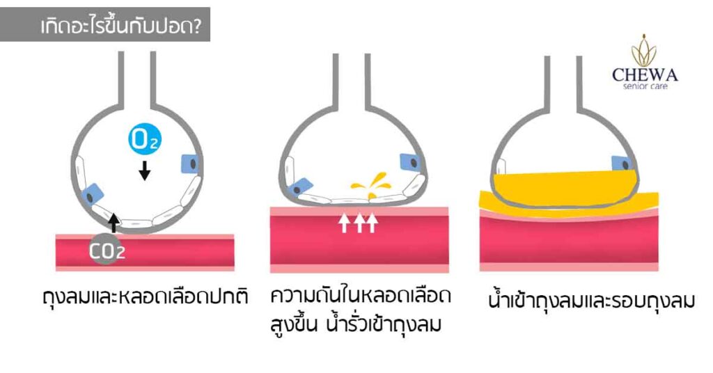 เมื่อ...หัวใจ ทำน้ำท่วมปอด