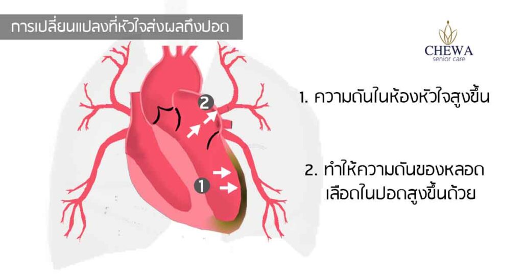 เมื่อ...หัวใจ ทำน้ำท่วมปอด