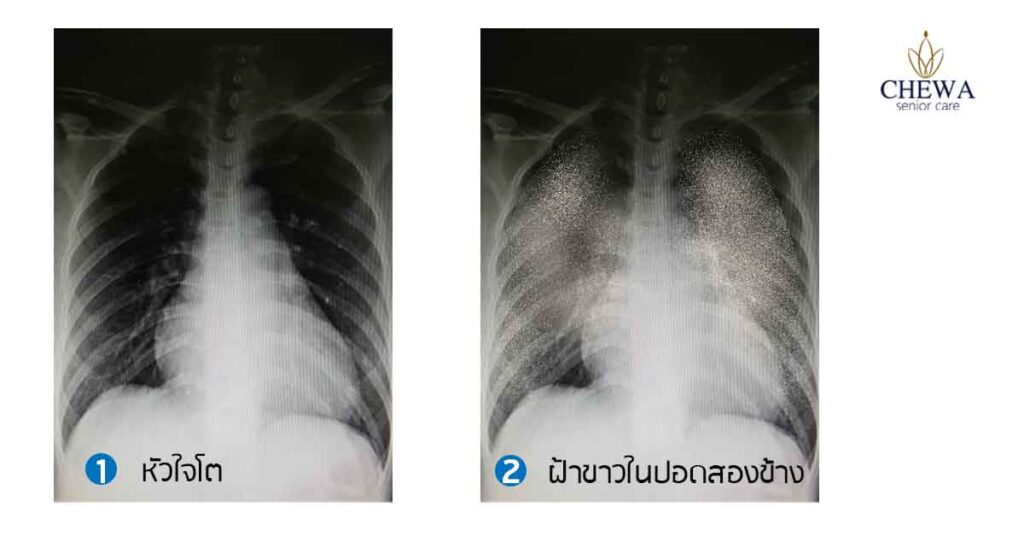 เมื่อ...หัวใจ ทำน้ำท่วมปอด