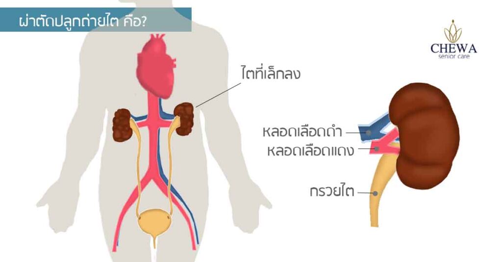 รู้จัก การผ่าตัดปลูกถ่ายไต ตอนที่1