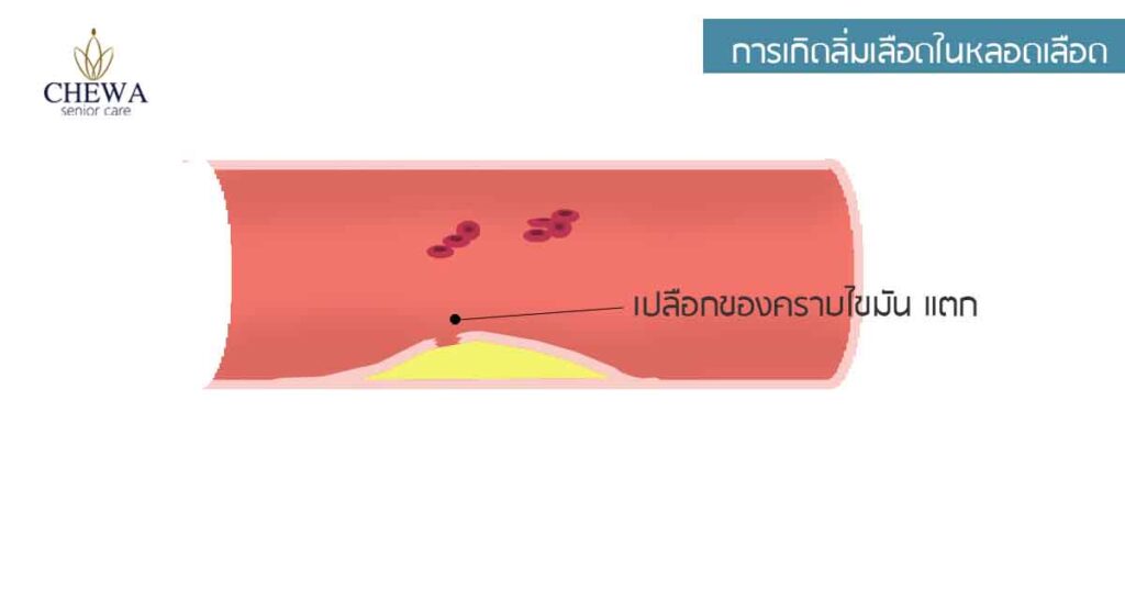 กล้ามเนื้อหัวใจตาย เกิดจากอะไร?