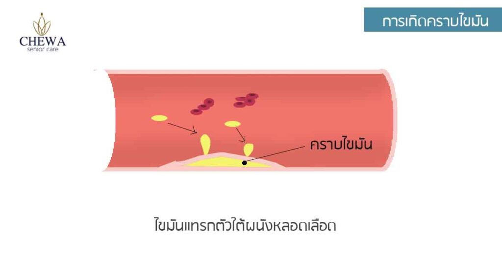 กล้ามเนื้อหัวใจตาย เกิดจากอะไร?