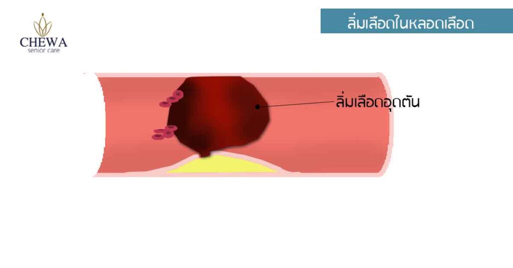 กล้ามเนื้อหัวใจตาย เกิดจากอะไร?