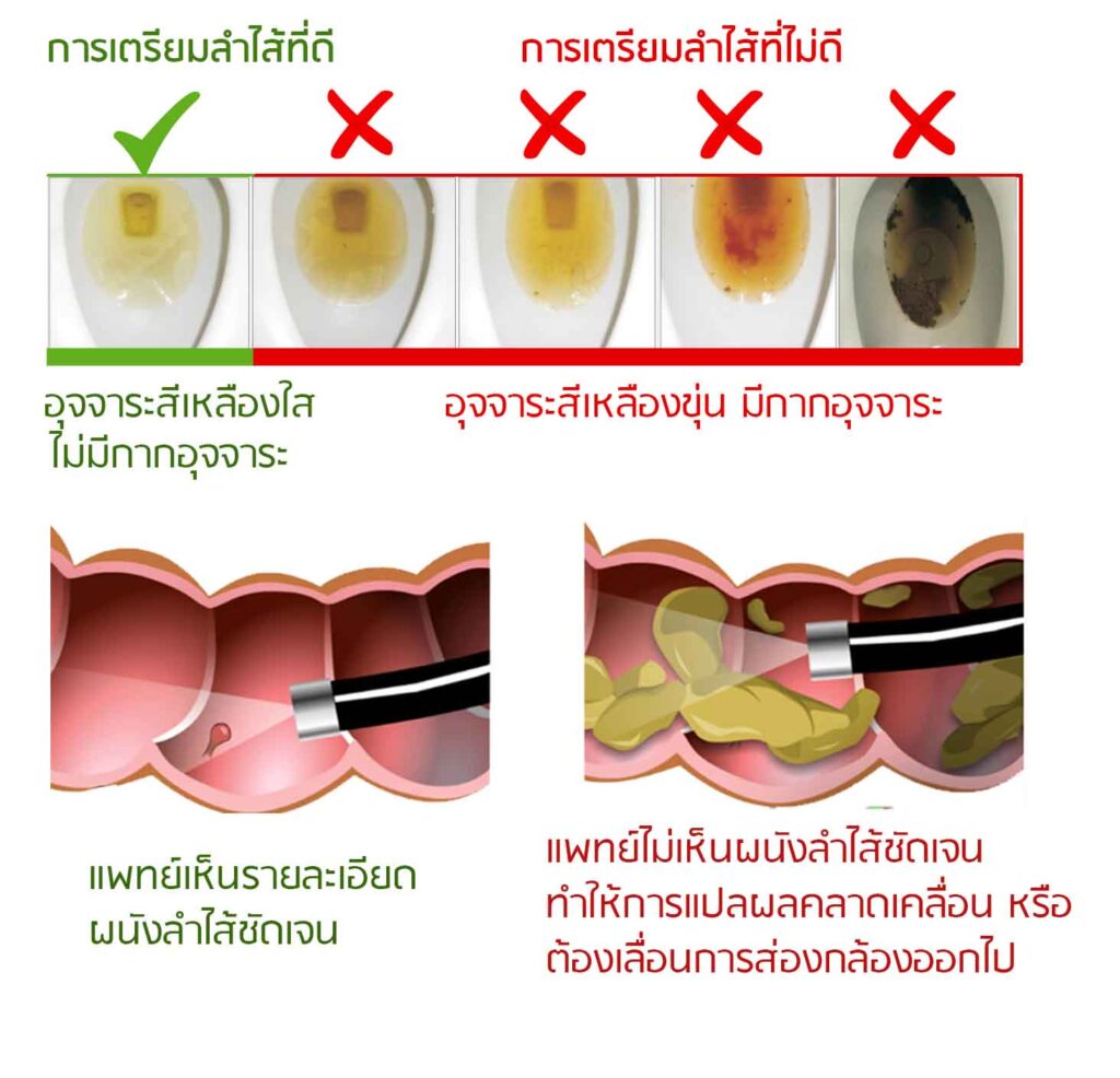 เตรียมลำไส้ ส่องกล้อง