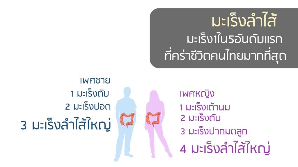 มะเร็งลำไส้