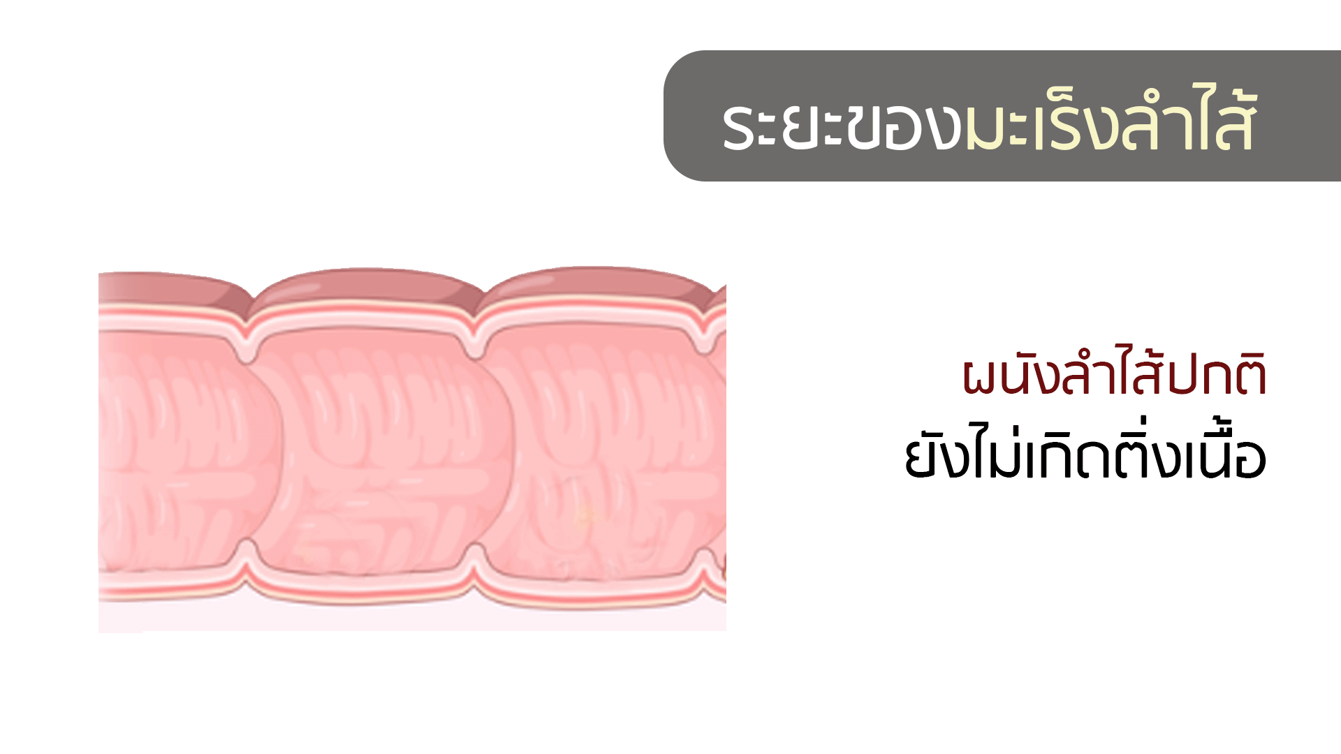 มะเร็งลำไส้
