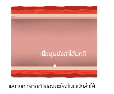 มะเร็งลำไส้